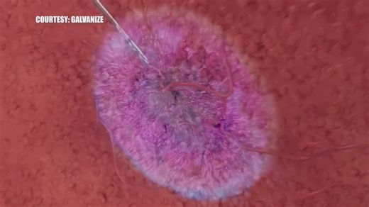 New electric pulse therapy gives hope to cancer patients