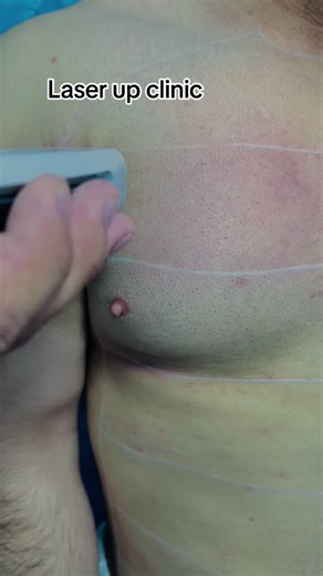 Effective Laser Hair Removal at Laser Up Clinic