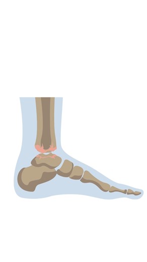 During Arthritis Month, learn more about treatment options for ankle arthritis from Duke Health foot and ankle orthopedic surgeon, Karl Schweitzer, MD 👉 https://duke.is/ankle-arthritis | Duke Health