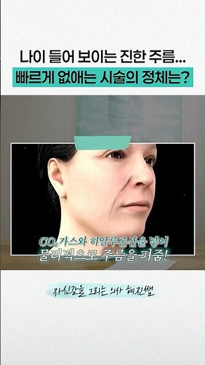나이 들어 보이는 팔자주름 없애는 가장 효과적인 시술