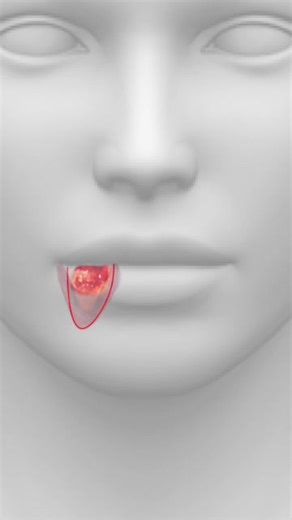 Lip Cancer Wedge Excision: Surgery Procedure Explained
