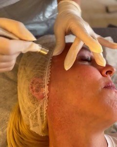 ITEC Level 3 Certificate in Microdermabrasion🔥 now enrolling for June 2023😍 ❌LIMITED PLACES LEFT❌ This course is an advanced beauty treatment which gives a deep exfoliation and resurfaces the skin😍 Microdermabrasion treatments use a minimally abrasive instrument to.. 🌟gently sand your skin ⭐️removing the thicker ⭐️uneven outer layer This type of skin rejuvenation is used to treat light scarring, discoloration, sun damage and stretch marks. treatment shows excellent results on minimising fine