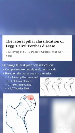 Herring Lateral Pillar Classification https://youtu.be/p6yky7JEnUU | Orthopaedic Principles