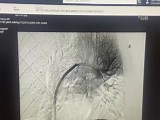 Successful Total Angiographic Pulmonary Embolectomy • Video • MEDtube.net