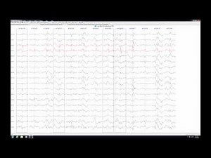 Reviewing Persyst spike detections using P12 SpikeReview