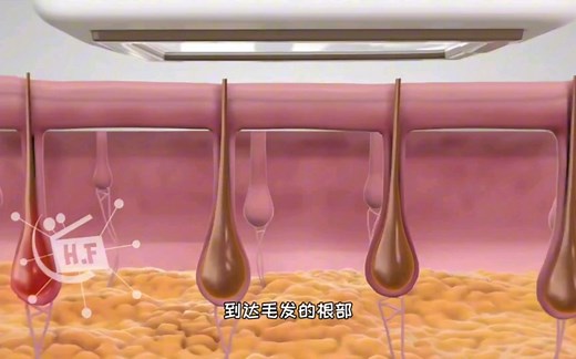 激光脱毛是永久的吗，激光脱毛原理，3D演示。。