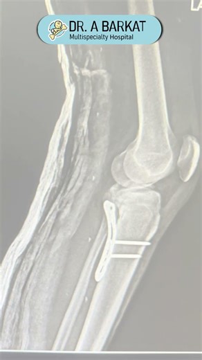 Patient Recovery After Posterior Plateau Tibia Fracture Surgery in Gaya #surgerysuccess