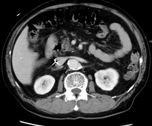 Transvenous lead extraction has been increasingly recognized as a safe and effective method of lead extraction, but there are only few references for extracting leads migrating outside the heart. Dr. Shogo Sakamoto, et al. present a successful extraction of a fractured pacemaker lead from the spermatic vein using several approaches and multiple tools. Read more in #JACCCaseReports: https://bit.ly/49aIiRe | JACC Journals