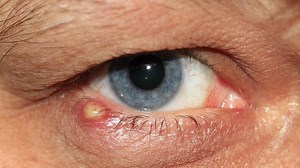 Niciodată nu stoarceți ulciorul de la ochi