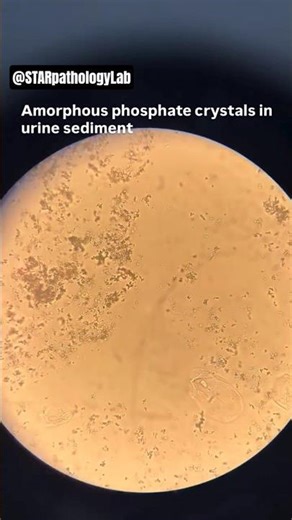 Amorphous phosphate || #urine #sediment #microscope