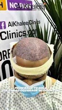 best hair transplant in karachi | MORE THAN 10,000 HAIR TRANSPLANTS DONE!! ALLHAMDULILLAH!! 🏆