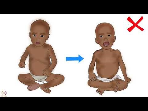 Lecture 58 : Spoken tutorials on WHO weight-for-age and length-for-age percentile growth charts