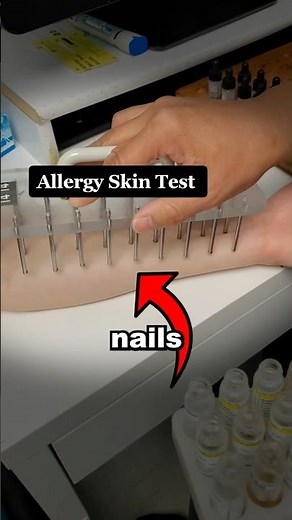 A Trick Doctors Use To Check For Allergies! (📸: @venusstam /TT)