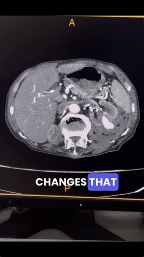 Renal Angiography Spot the Finding What’s This #shorts