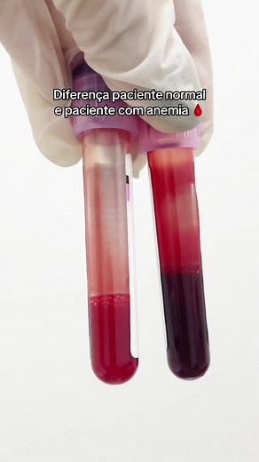 Diferença paciente normal e paciente com anemia 🩸