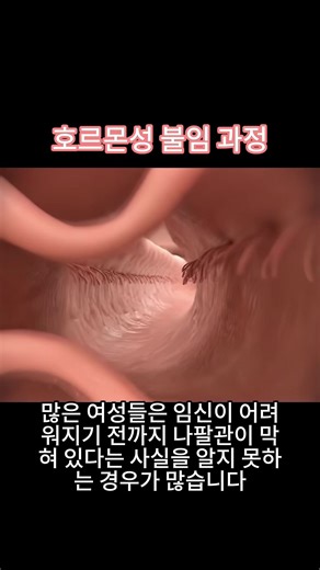 Understanding Fallopian Tube Blockage and Infertility