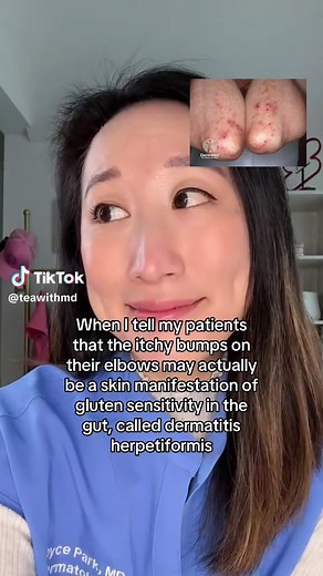 Itchy Bumps on Elbows: Understanding Dermatitis Herpetiformis