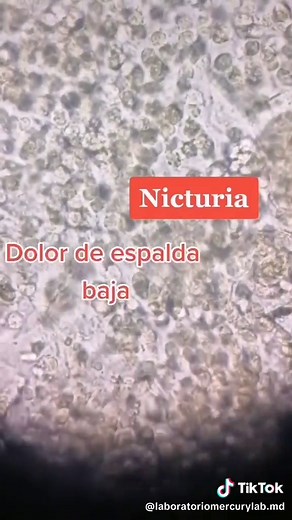 Infección en Orina: Filamentos Mucoides y Su Significado