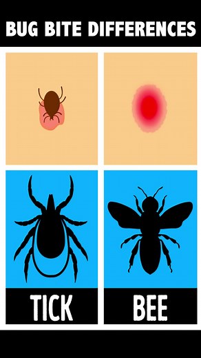How to Identify a Bug Bite and What to Do With It #bug #bite | Smart is the New Sexy