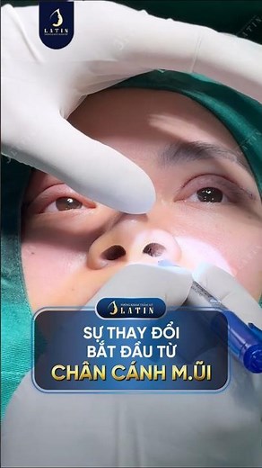 Thu Gọn Cánh Mũi & Cuộn Chân Mũi: Hết To Bè Sau 30 Phút | Bác sĩ Trịnh Quang Đại