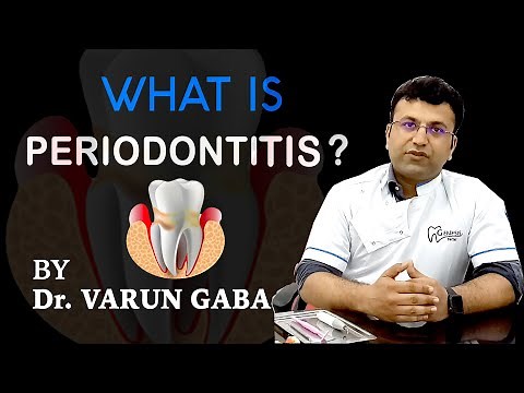 Periodontitis - Gum Disease | Pyria | Symptoms & Treatment | Star Imaging & Path Lab |Dr Varun Gaba