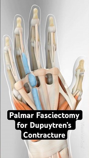 Treating Viking's Disease (3D Animation)