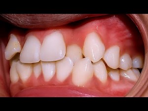 My Journey Fixing Crowded Teeth and a Crossbite | Braces Transformation