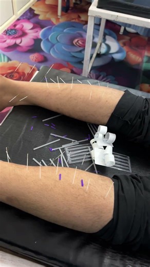 Heel Pain Relief Instantly with Dry Needling | Plantar Fasciitis Treatment
