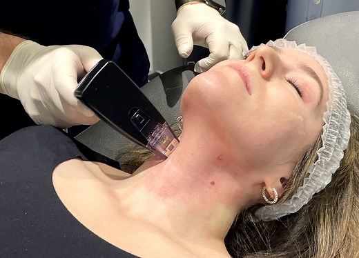 I Tried Morpheus8—and It Didn’t Hurt at All. Here’s Why.