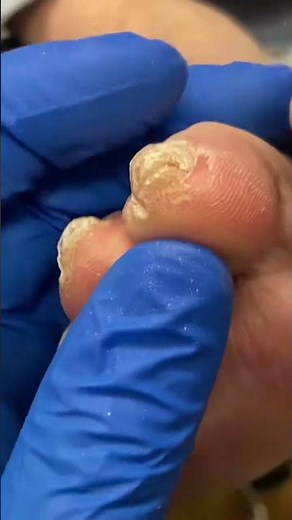 Experience toe-tingling relief! The Aussie podiatrist takes over callus removal!