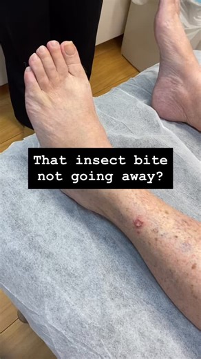 Dr John O’Bryen | Specialist GP on Instagram: "Are you a health professional and want to learn dermoscopy? 🔍 I recommend the certificate dermoscopy courses by @healthcert Use discount code DRJOHN for a 15% discount. Are you from the U.S. 🇺🇸 and want to learn the basics of skin cancer medicine and how to introduce it into your practice? I recommend the Skin Cancer Medicine Accelerator Program by MoleScan. Use discount code DRJOHNUS See links in bio for more information. #dermoscopy #skincancer