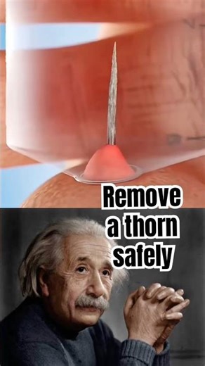 Thorn stuck in your leg? 🔥 careful way to remove it | sigma physics teacher