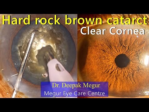 Secrets for post op clear cornea after Phacoemulsification of a rock Hard Cataract ..! Dr Deepak