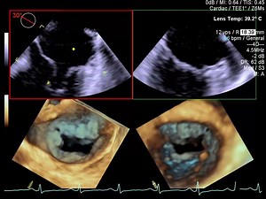 When performing surgical procedures, uninterrupted imaging, higher sensitivity, and higher volume rates are critical. To support the lengthy scan times required in these procedures, it becomes essential to have a transducer that offers advanced thermal management to minimize interruption due to transducer overheating. A transducer that is fully shielded to minimize Electromagnetic Interference (EMI) allows clinicians to image without disruption: http://sie.ag/1S8cHRc | Siemens Healthineers