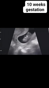 10 weeks gestation #fetalscans #pregnancy #ultrasound #radiology | Radiology Interesting