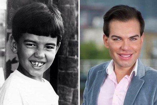 What did Rodrigo Alves look life before and what surgery has the Human Ken Doll had?
