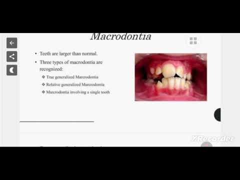 Macrodontia and microdontia || oral pathology