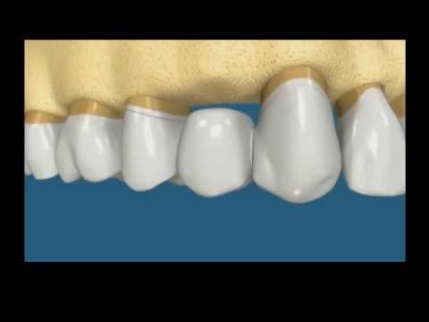 flossing 3 unit bridge.mp4