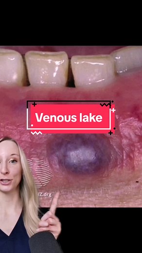 Understanding Venous Lakes on Your Lips