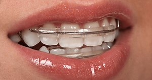 Inman Aligner Review: Cost, Problems & Comparison vs Invisalign