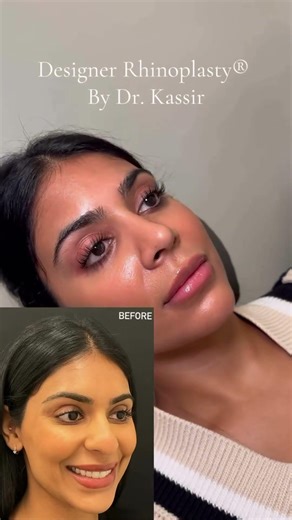 One Month Nose Reveal | Dr. Ramtin Kassir | New York City #shorts