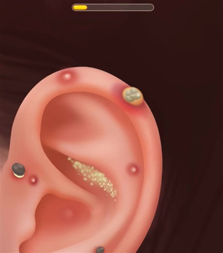 100K views · 654 reactions | ASMR Satisfying  Piercing Pus Treatment Animation, Ear Acne Blackhead Extrusion, Sebaceous Cyst | #facebookreels #asmrvideo #videos #asmrsatisfying #viralshorts #asmrcommunity #asmrcleaning #FacebookReelsContent #asmreating #viralreels2025 #facebookreel | ASMR | Facebook