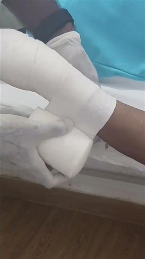 Below elbow cast application step 1
