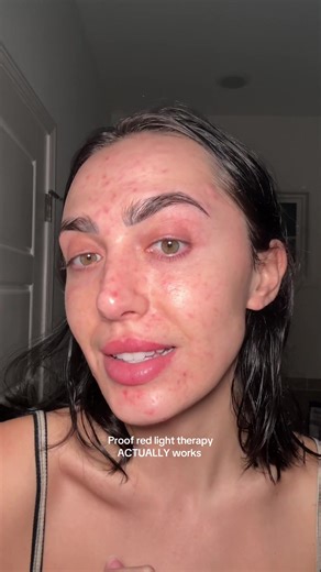 Transform Your Acne-Prone Skin with Red Light Therapy
