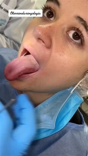 Práctica de Otorrinolaringología. ¿Qué se observa? Cavidad Oral (Labios, dientes, lengua, paladar duro y blando, uvula) laringe (Epiglotis, vallecula, cuerdas vocales). Además, presenta Vía área fácil (Mallampati I). #medicina #otorrinolaringologia #practicas #estudiante