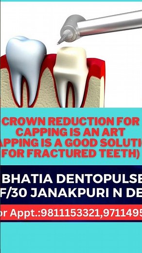 Crown reduction(process of capping ) is a painless procedure to save your broken tooth #crown