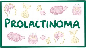Prolactinoma: Video, Causes, & Meaning | Osmosis