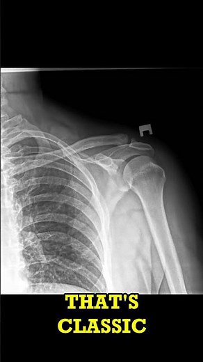 Shoulder Osteoarthritis X-Ray Short
