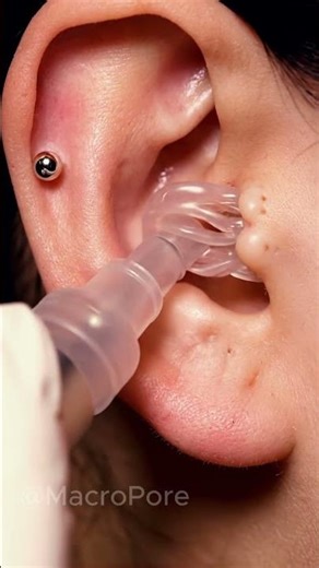 Clinical Ear Blackhead Extraction | Vacuum Pore Cleansing ASMR #4kmacro #satisfying #macroasmr