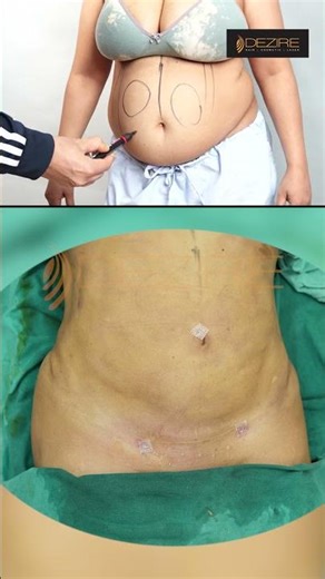 360 Abdomen Liposuction
